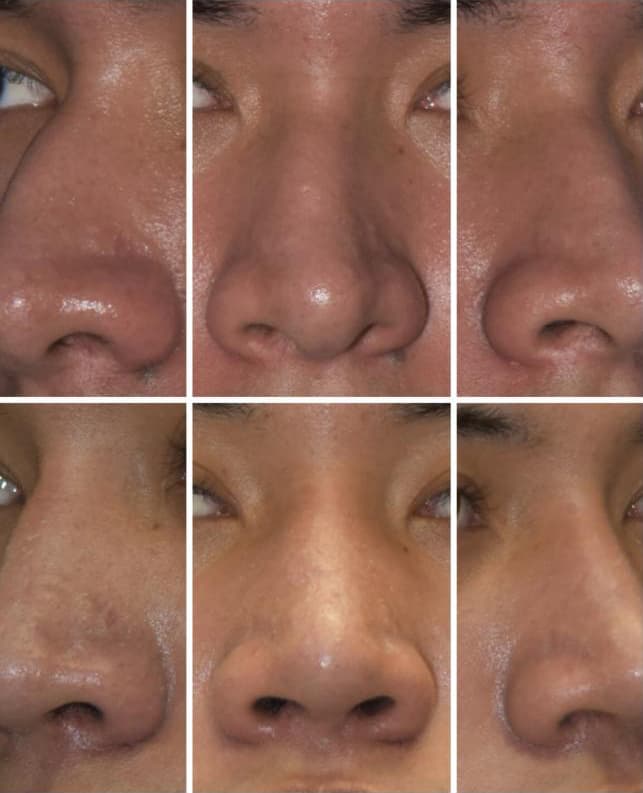 Before and after rhinoplasty results